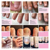 IBX Treatment before and after